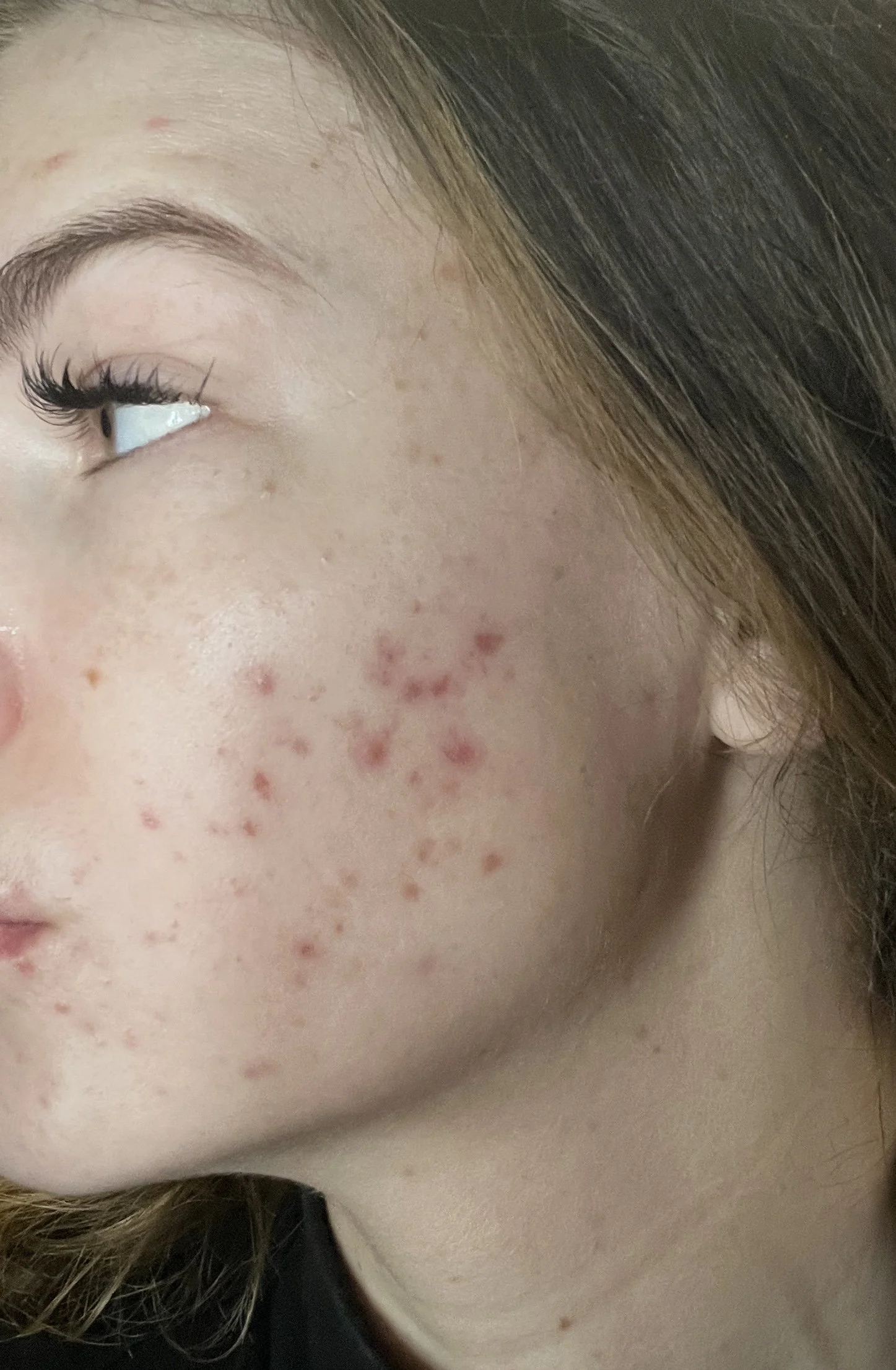 Close-up of inflammatory cystic acne on cheek during peak breakout phase in 2024.
