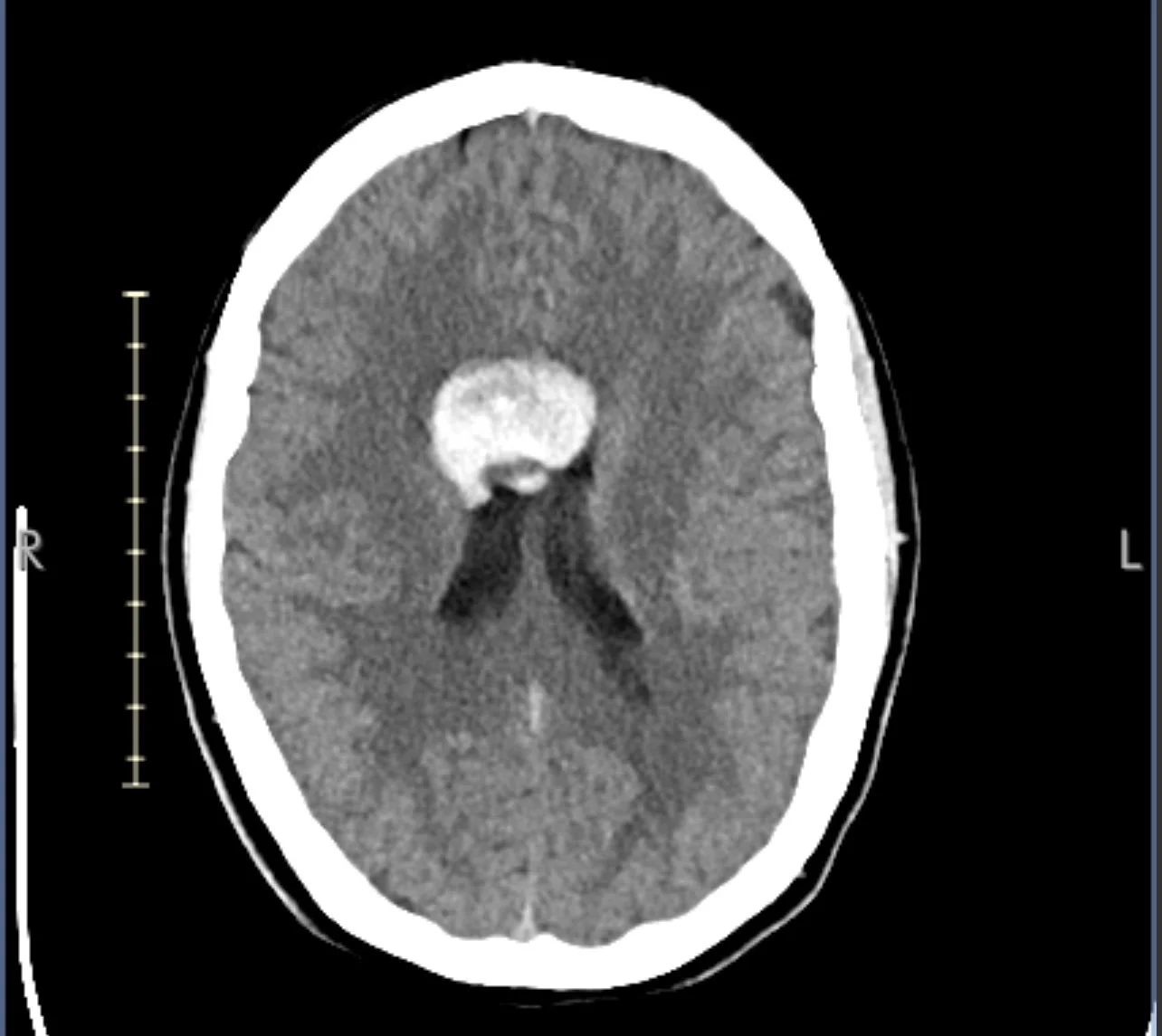 CT scan showing ventricular vascular malformation prior to surgical removal.