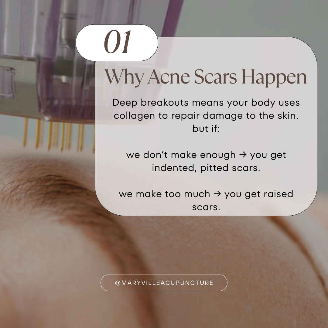 a close up of microneedling on the unbroken skin to treat acne scarring with the text " Why acne scars happen and a summary of the text next to it.