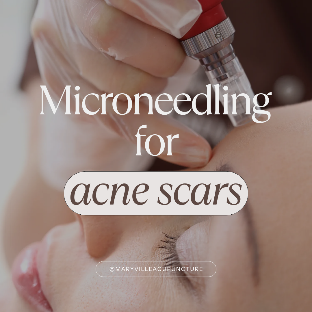 Can Microneedling Erase My Acne Scars? 