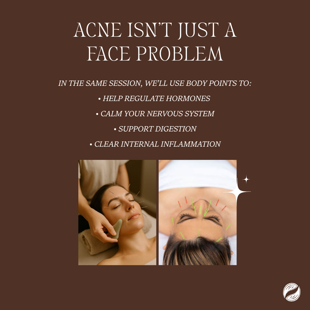 Close-up of a person's face receiving very fine cosmetic acupuncture needles and gentle gua sha for acne treatment, showing the calming, anti-inflammatory effect. Text: "Acne isn't just a face problem. in the same session, we'll use body points"