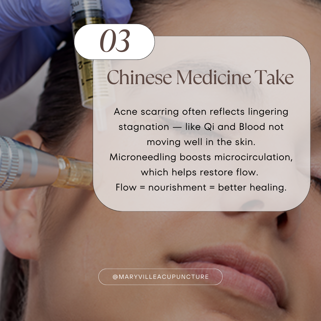 Close up of micorneedling pen with serum application nearby on a woman's face for acne scaring. Text summarizes this section of the blog about the Chinese medicine perspective of scarring.
