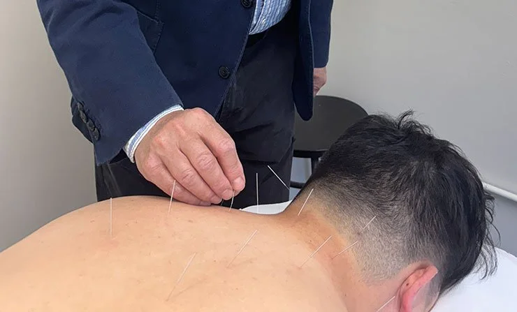 Person receiving acupuncture treatment with multiple acupuncture needles inserted into their back while a practitioner adjusts a needle.