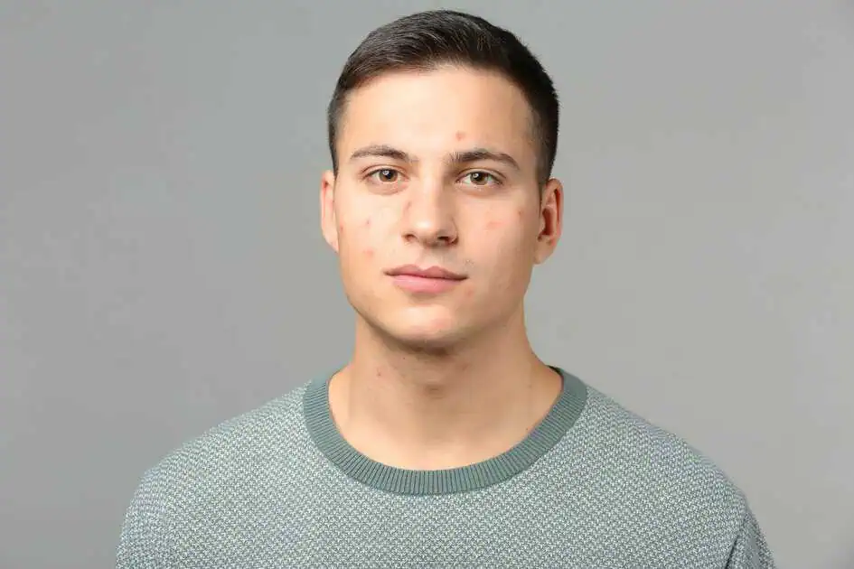 Subcision for Men: Effective Solutions for Acne Scars and Skin Concerns