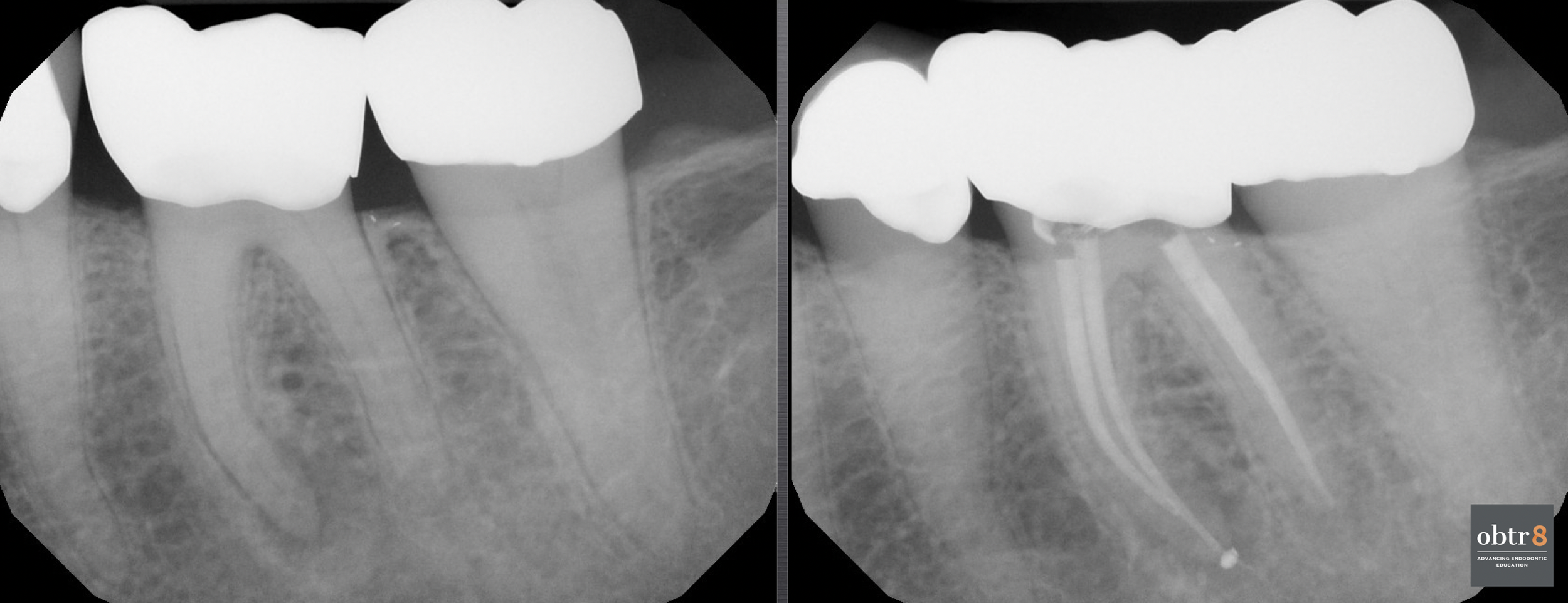 OBTR8-David-Landwehr-dental-xray-1.png