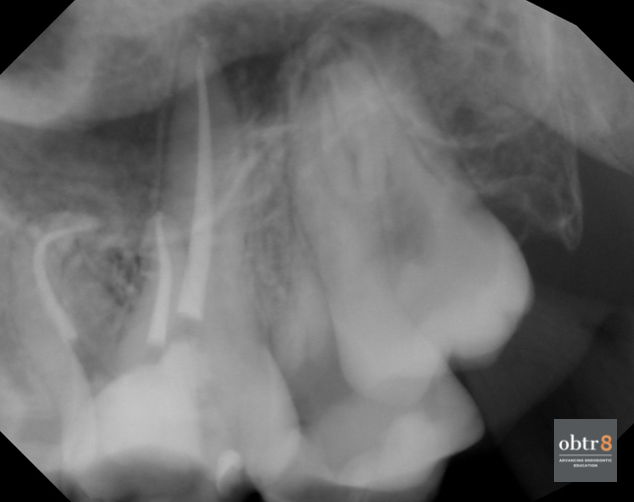 OBTR8-David-Landwehr-dental-xray-3.png