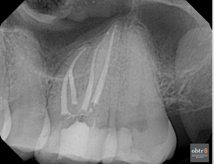 OBTR8-David-Landwehr-dental-xray-4.png
