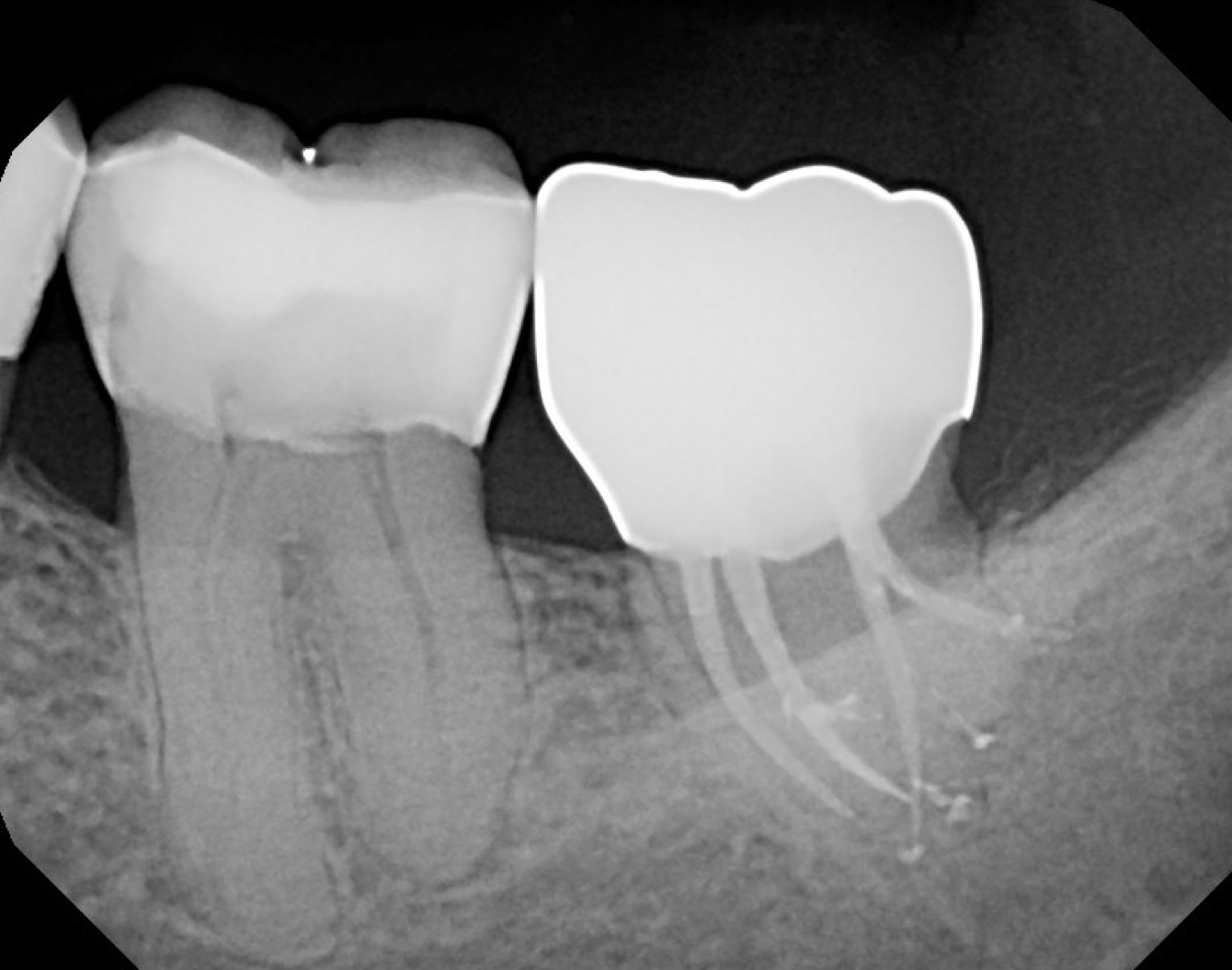 OBTR8-David-Landwehr-dental-xray-5.png