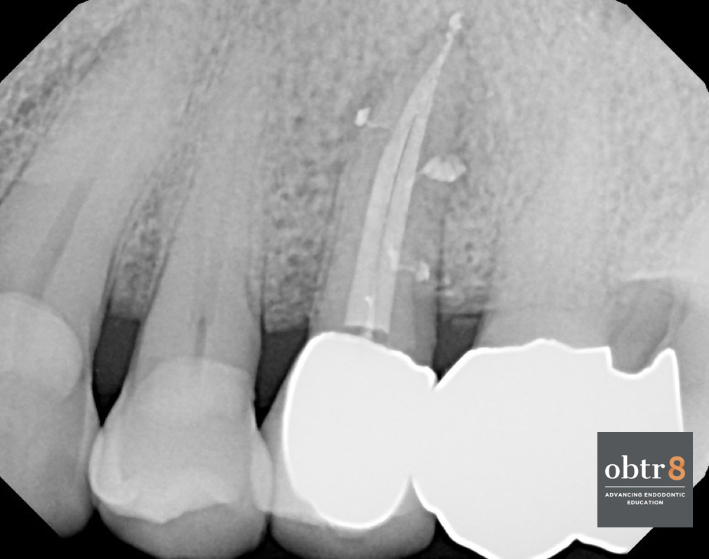 OBTR8-David-Landwehr-dental-xray-6.png