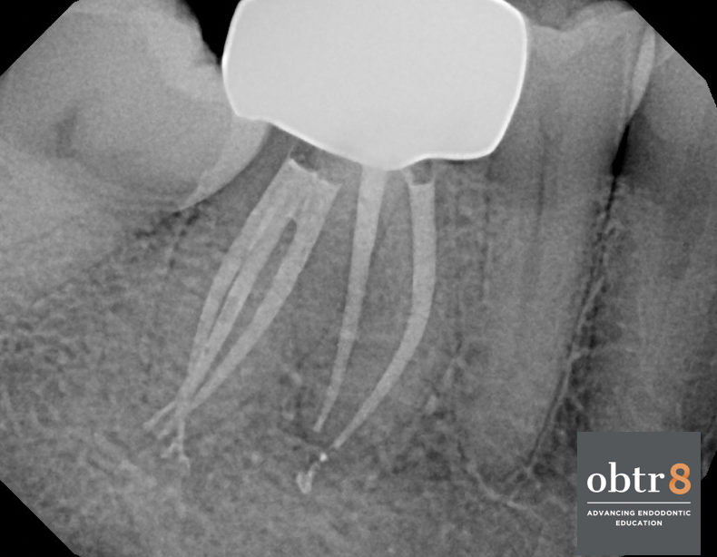OBTR8-David-Landwehr-dental-xray-7.png