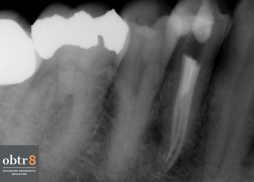 OBTR8-David-Landwehr-dental-xray-8.png