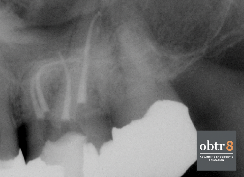 OBTR8-David-Landwehr-dental-xray-9.png