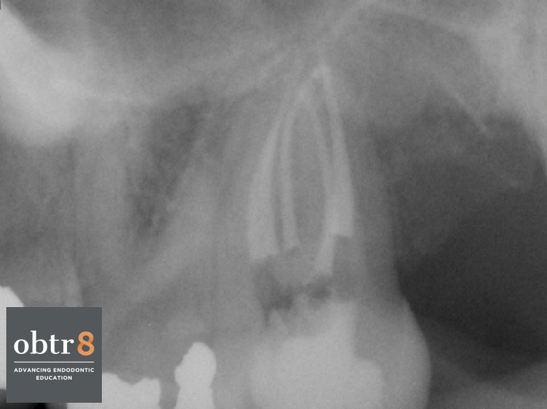 OBTR8-David-Landwehr-dental-xray-10.png