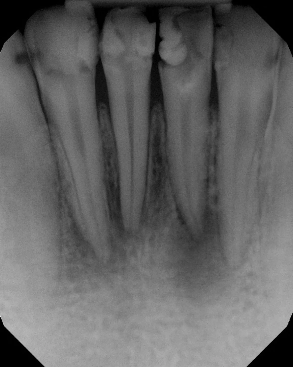 Same teeth. Three moments in time. One healthy outcome.
From diagnosis to obturation to final restoration &mdash; this case shows what&rsquo;s possible when endodontics and restorative dentistry work in sync.
✔ Clean canals
✔ Proper seal
✔ Definitive