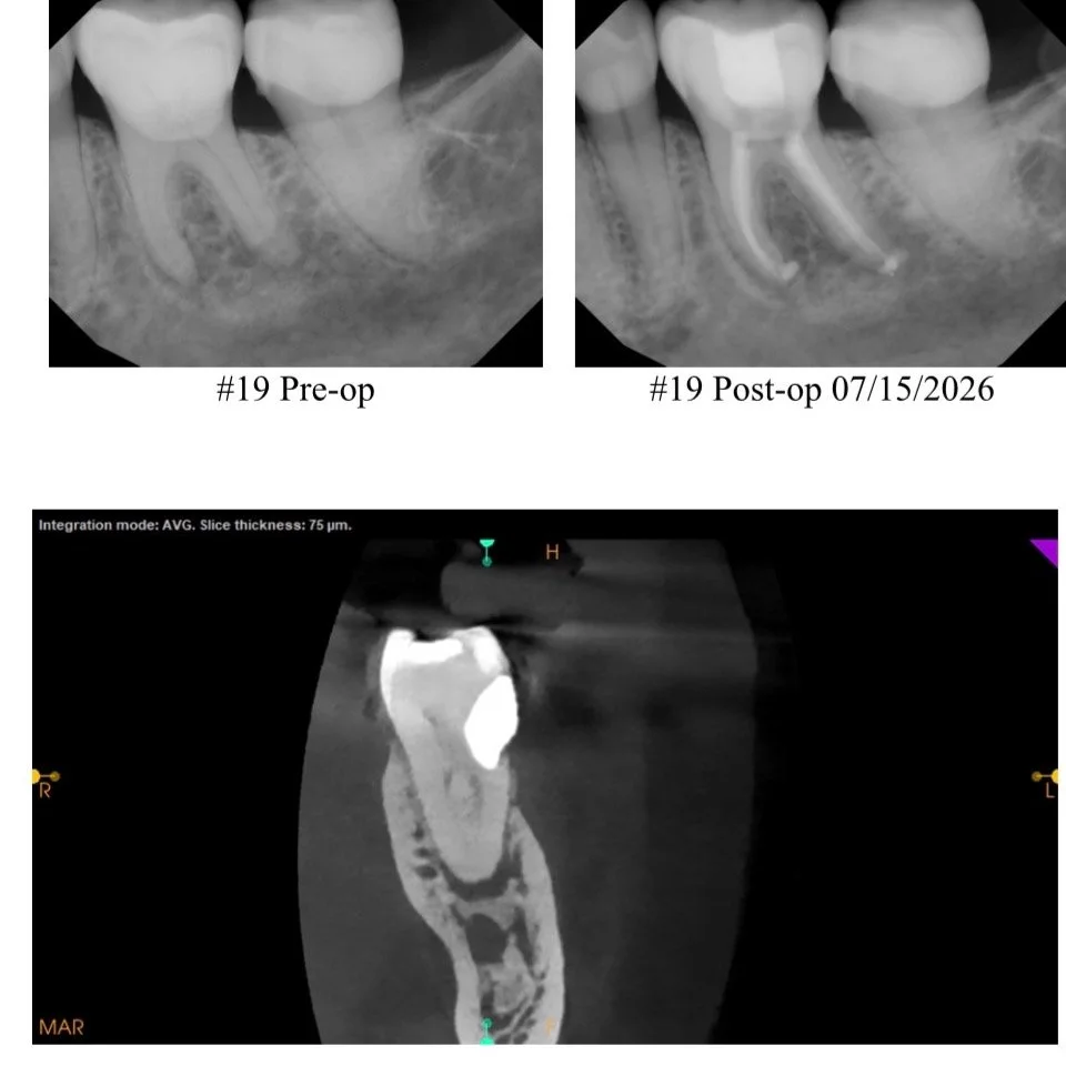 Deep restoration obscuring DB canal. WaveOne gold reciprocating orifice opener to the rescue. Used WaveOne orifice opener to center each canal over the root and clean top half of the root canal system. At that point any instrument would get to the ap