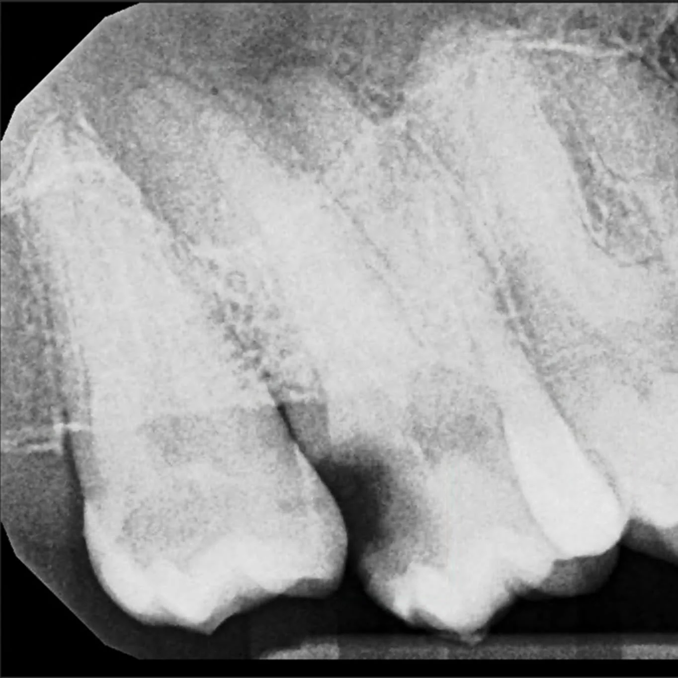 Case is courtesy of Qi Dai,DDS 
I take great pride in providing exceptional patient experiences and clinical outcomes, but it might be more gratifying and impactful to share my years of experience with young clinicians allowing them to achieve the sa