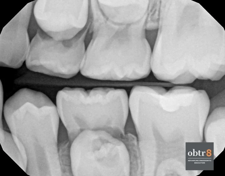 The pulp has amazing healing potential. Retained primary tooth with caries and breakdown into pulp of # 20. The caries and inflamed pulp were removed from chamber and bleeding was controlled prior to sealing the canal with MTA. Unknown prognosis init