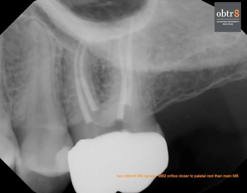 Not all mx molars have four canals visible on final radiograph, but the great majority have four canals. The position of the MB2 (ML) is highly variable. It can be close to main MB. Sometimes very lingual - closer to palatal orifice. Not uncommon to 