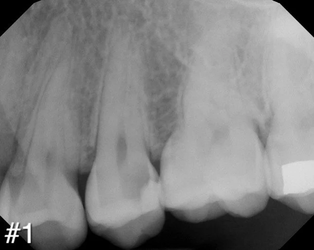 Our patients don&rsquo;t care about a marketing message; they want a great experience. Both cases were treated with Reciproc- Case # 1 (#13) was treated with no glide path and a single R25 for final shaping. Case # 2 (#12) had similar anatomy but a W
