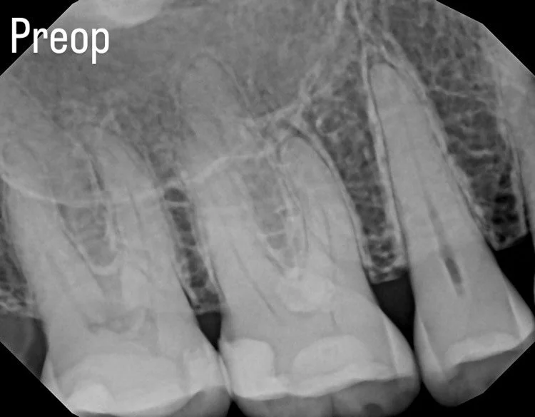 Last case of the day.  Necrotic pulp. ML canal several mm apical to pulpal floor and CEJ.  Waveone gold orifice opener prior to final shaping with reciproc blue minima. #obtr8 #waveonegoldorificeopener
#singlebuttonsolution 
#betterendo
#endodontics