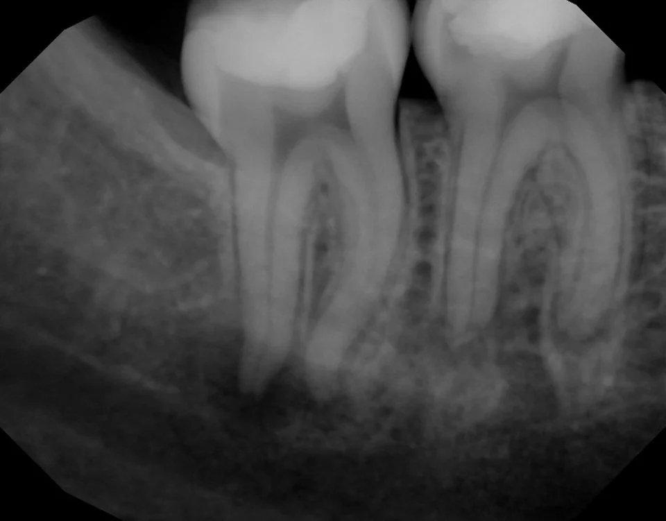 Complicated anatomies require complicated solutions, but some concepts are non negotiable. WaveOne gold orifice opening in coronal portion of each root to allow access to apical half of root. # 30 finished with reciproc blue R25- no scout, no glide p