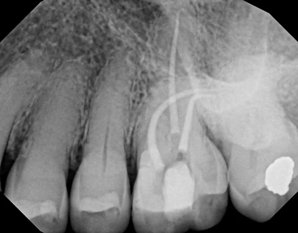 A big continuous curve in MB - WL 26mm. Extreme 90 degree curve near apex of DB - WL 23mm. Palatal was unremarkable by comparison - WL 24mm . WaveOne Gold orifice opening in top third of root facilitated access to apex.
#obtr8
#singlevisitendodontics