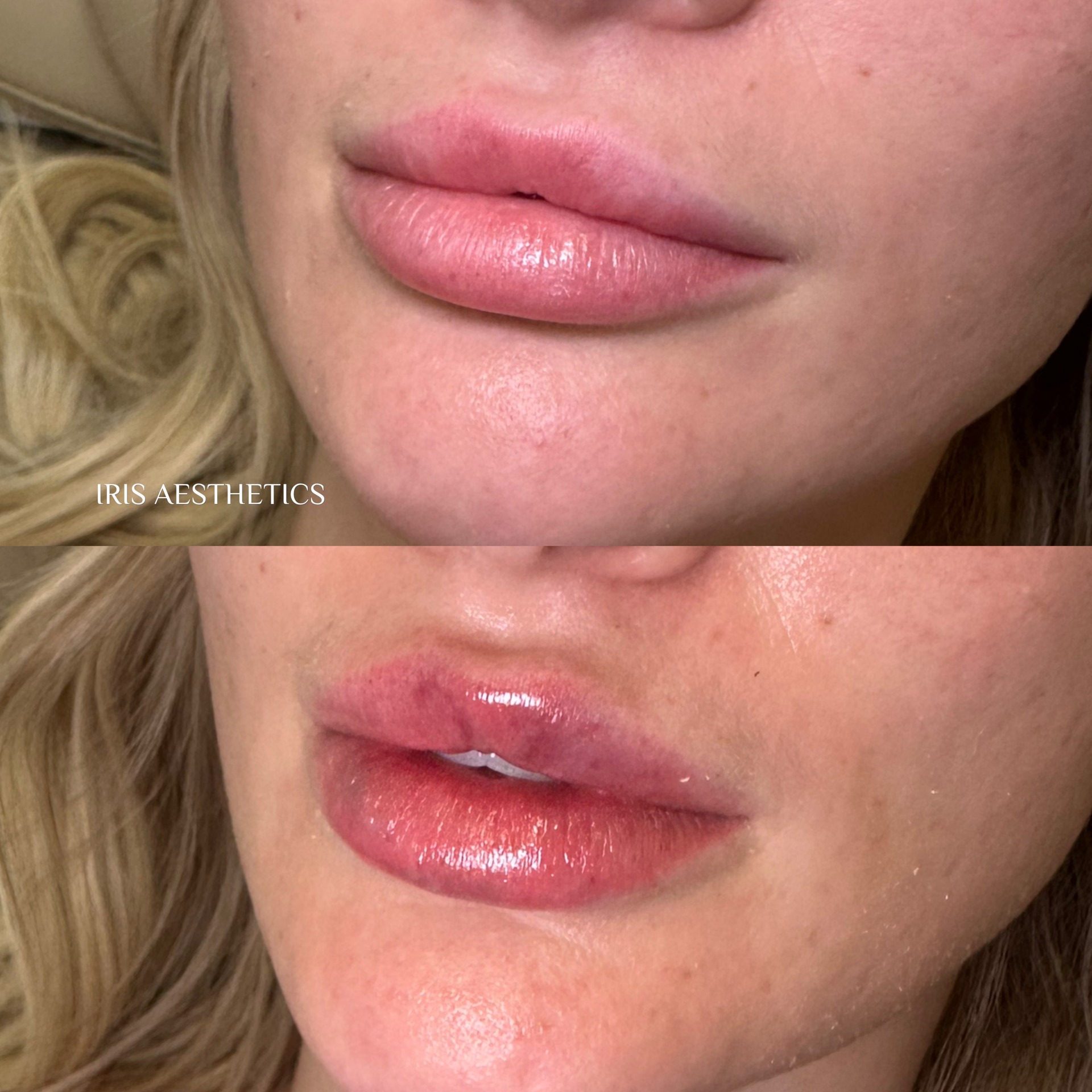 Close-up of a woman's lips, showing before and after a lip gloss application. The top image shows natural lips, and the bottom image shows lips with shiny gloss and a slightly fuller appearance.