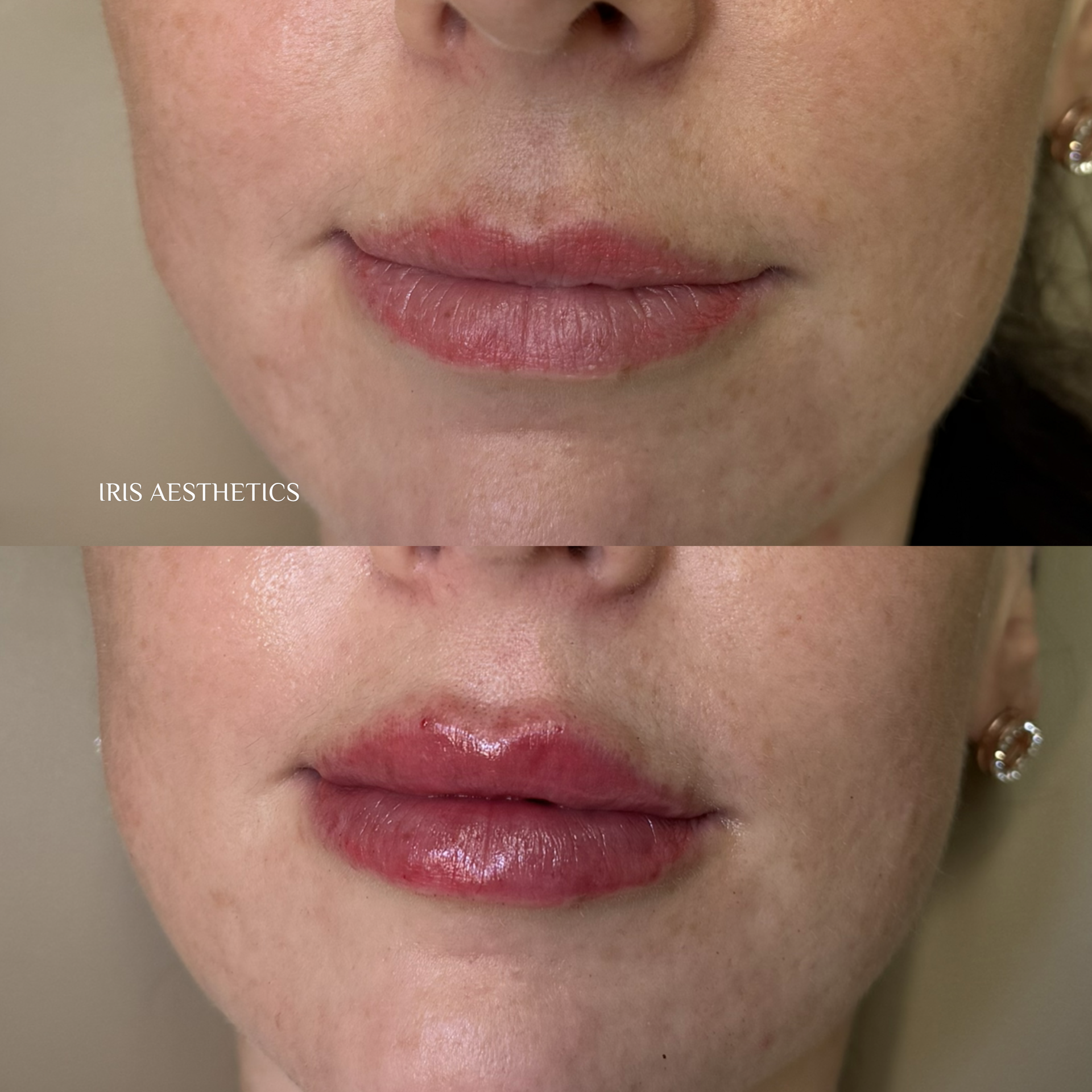 Close-up of a woman's lips before and after a cosmetic lip treatment, showing smoother and glossier lips in the after image.