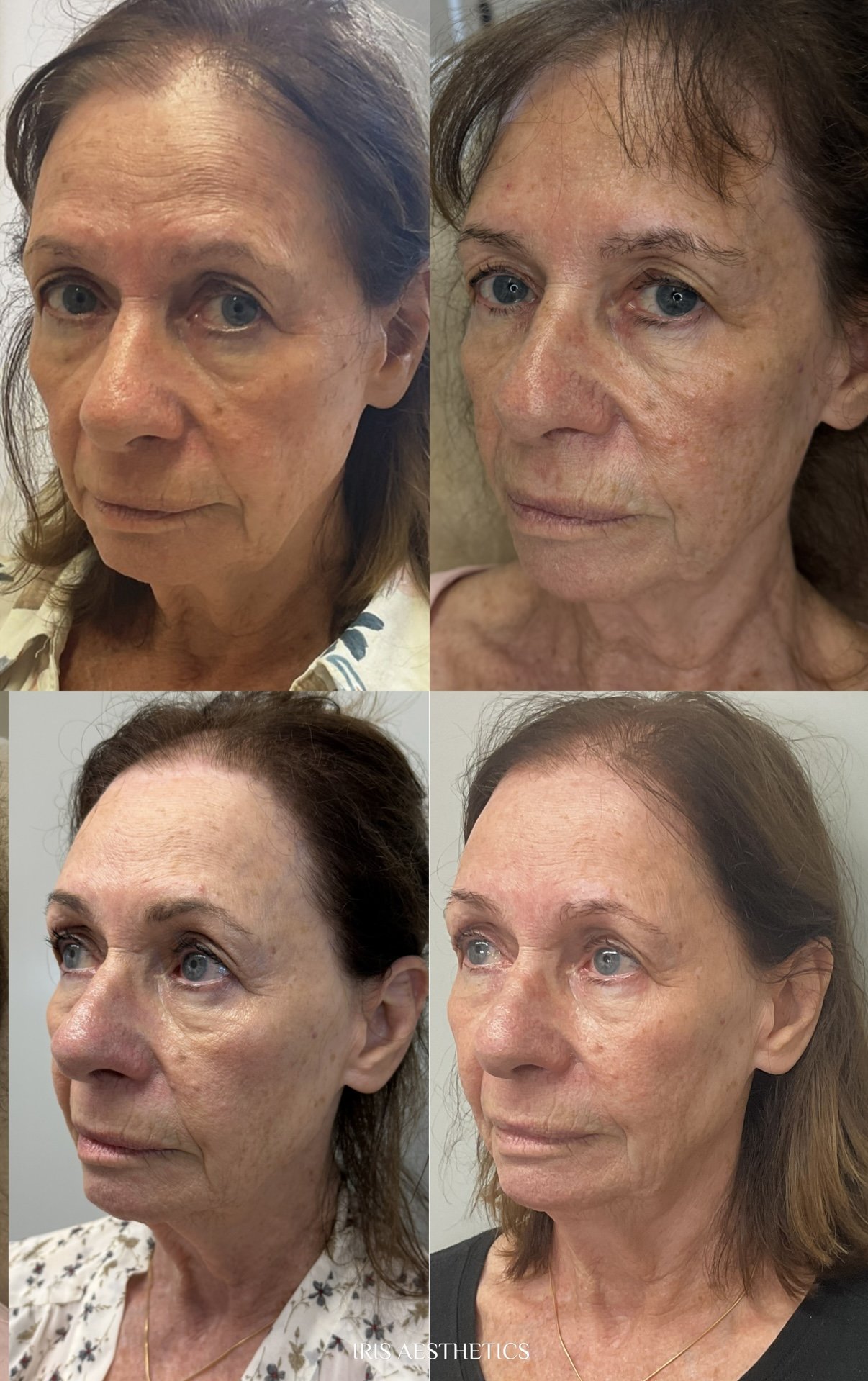 Before and after images of four women showing skin improvement treatments, with visible reduction in wrinkles, age spots, and skin texture.
