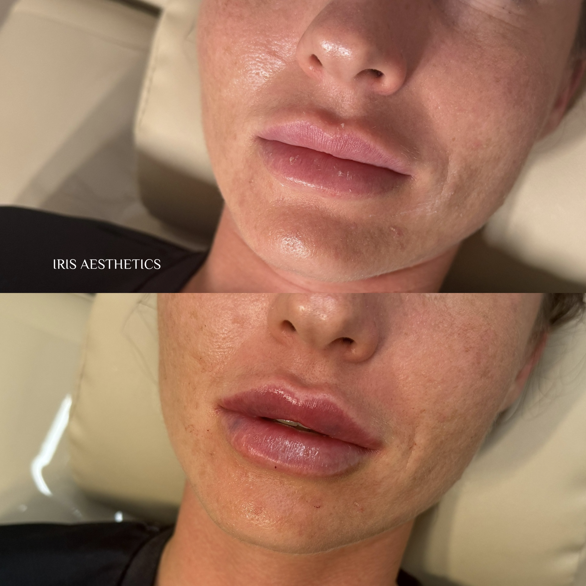 Close-up of a person's face before and after a cosmetic lip enhancement procedure showing fuller, more defined lips in the after image.