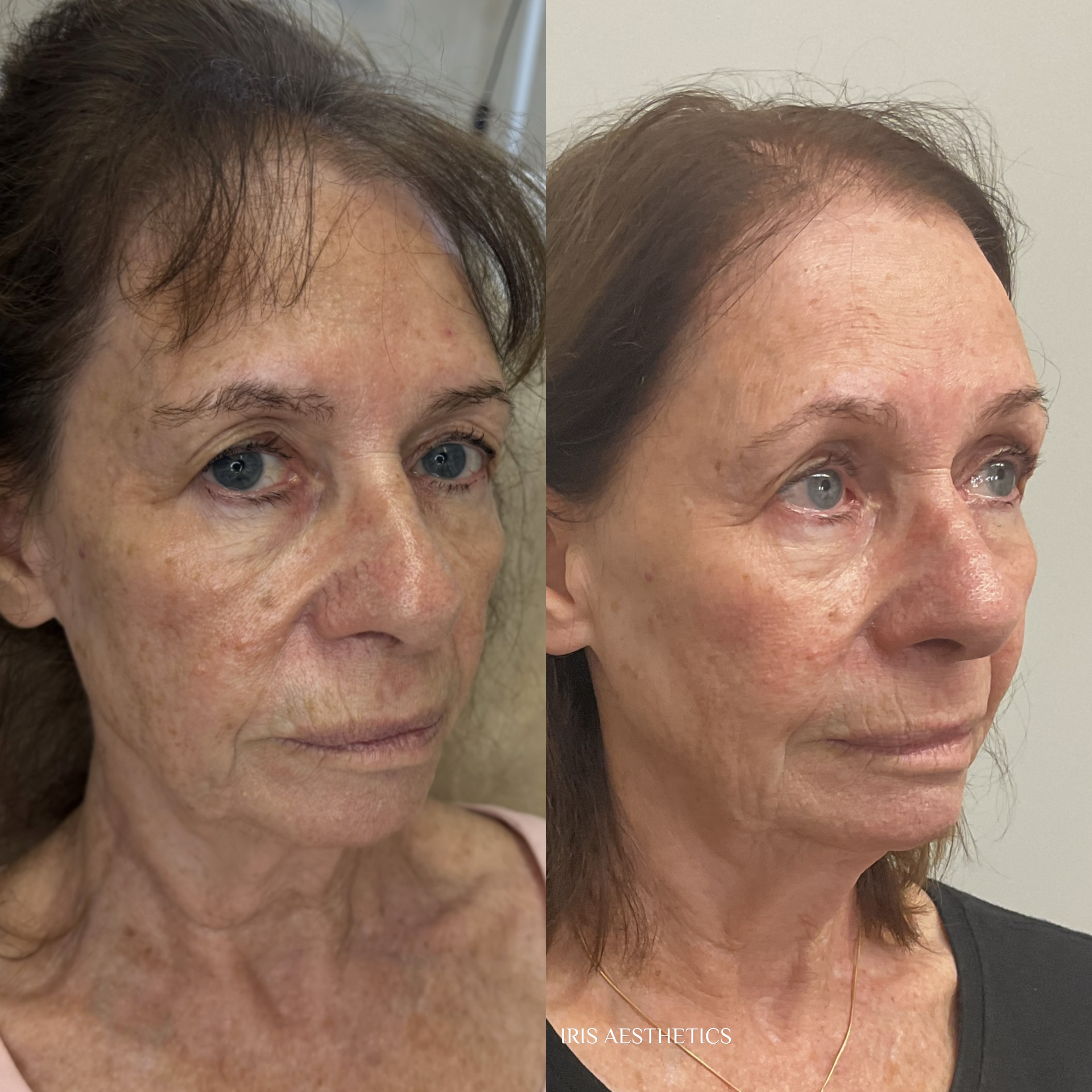 Comparison of a woman's face before and after skincare treatment, showing improvements in skin texture, pigmentation, and clarity.