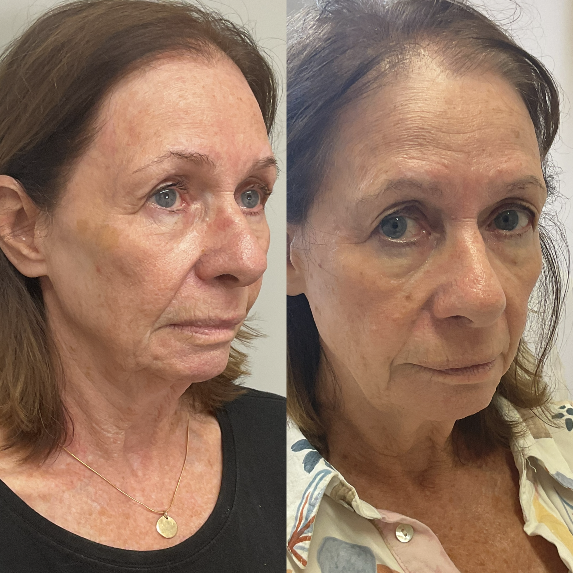 Side-by-side comparison of a woman before and after skincare treatment, showing improved skin texture and appearance.