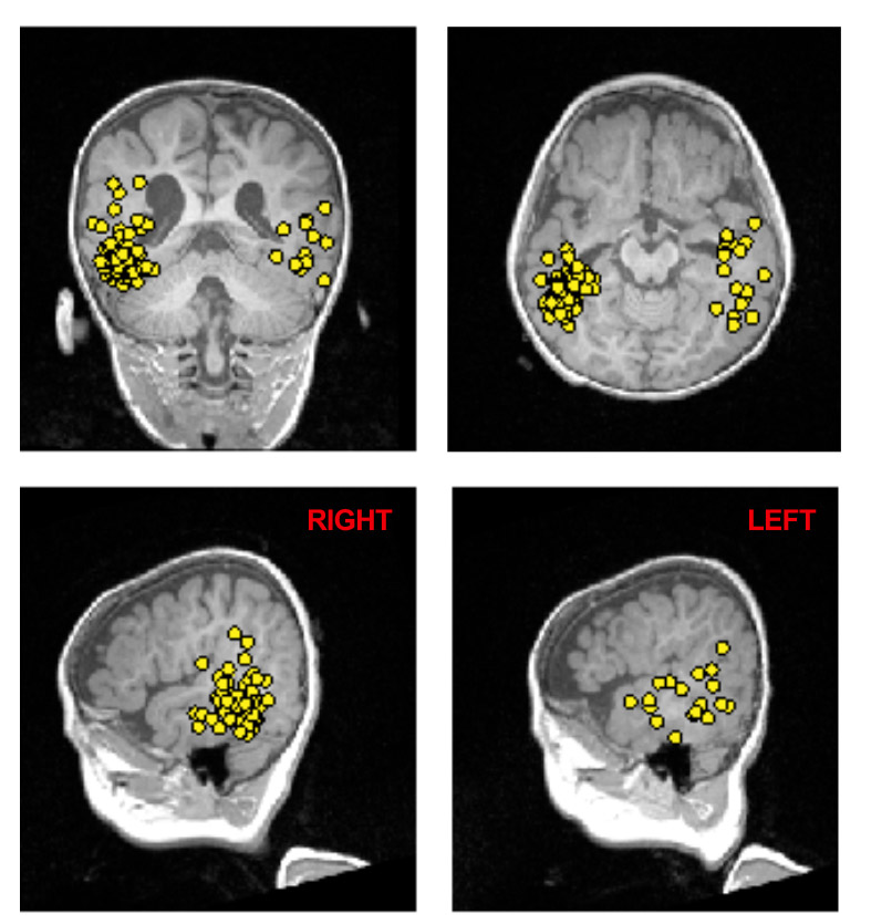 Meg Risk What is MEG? — American Society of Functional Neuroradiology