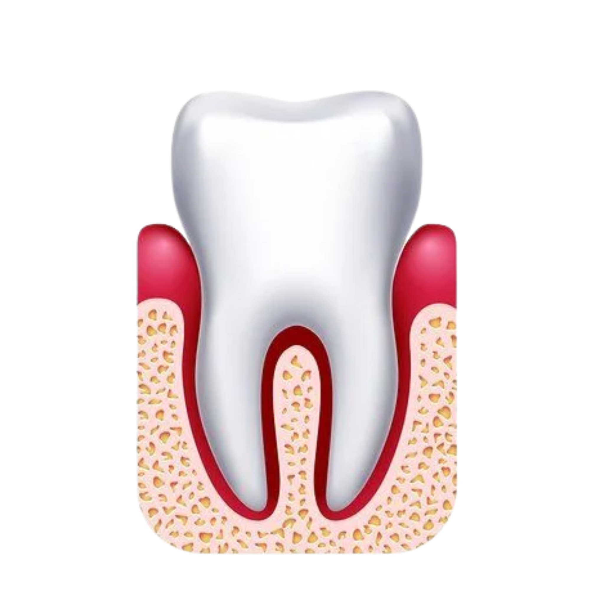Illustration of gingivitis showing red, inflamed gums around a tooth