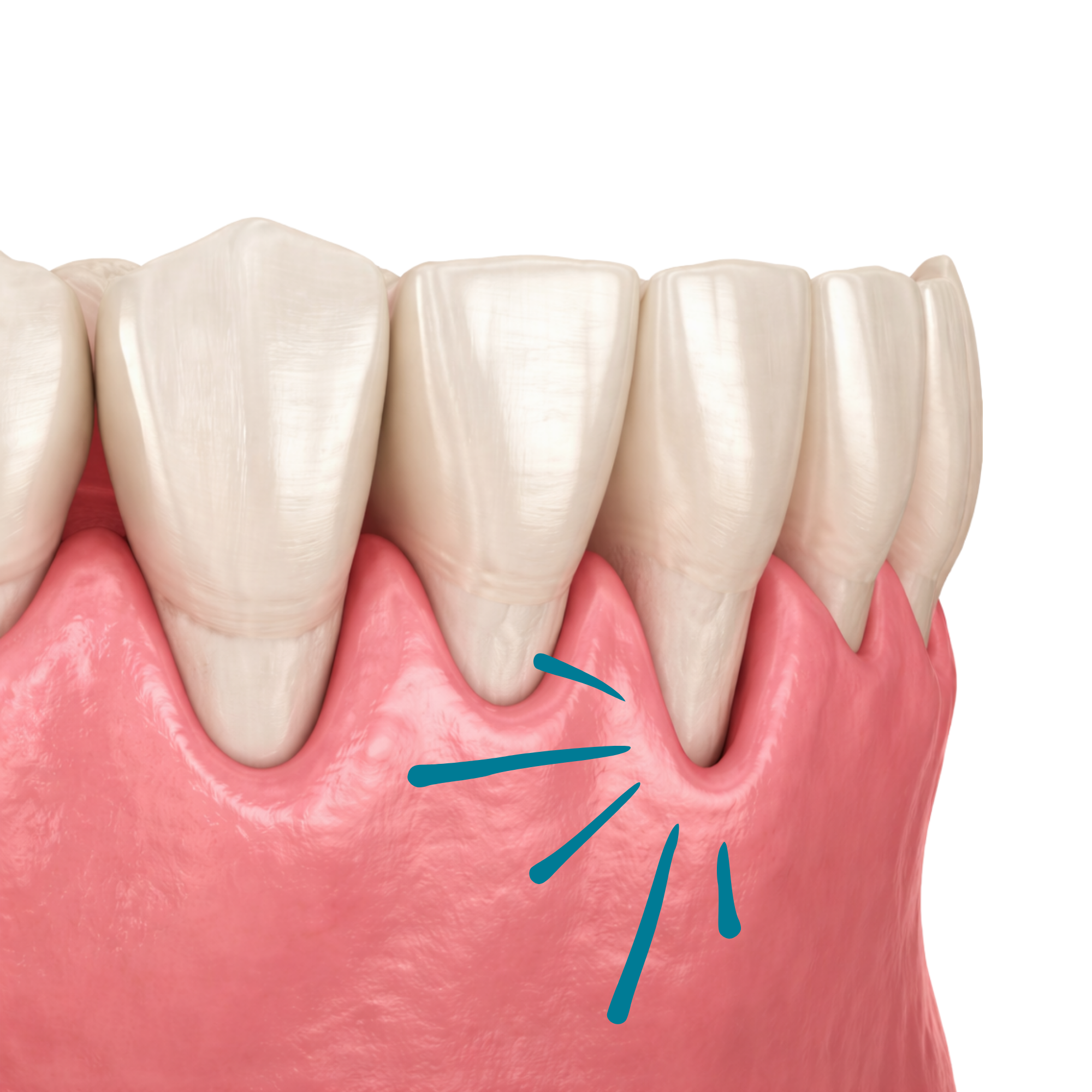 Receding Gums Awareness Month