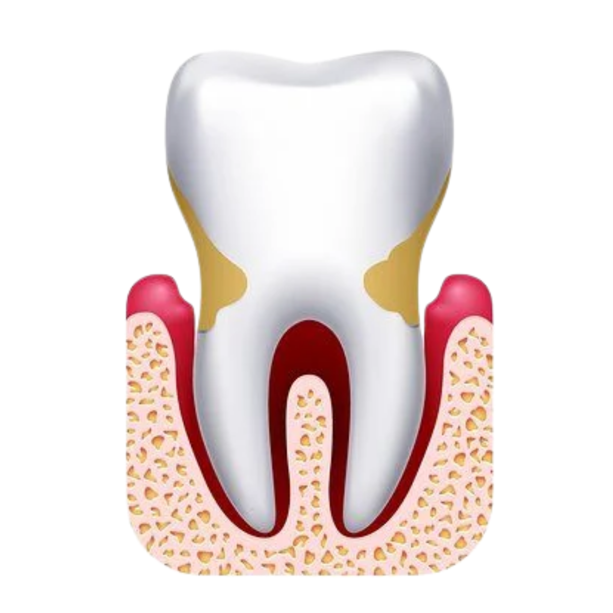 Illustration of periodontal disease showing gum recession and early bone loss around a tooth