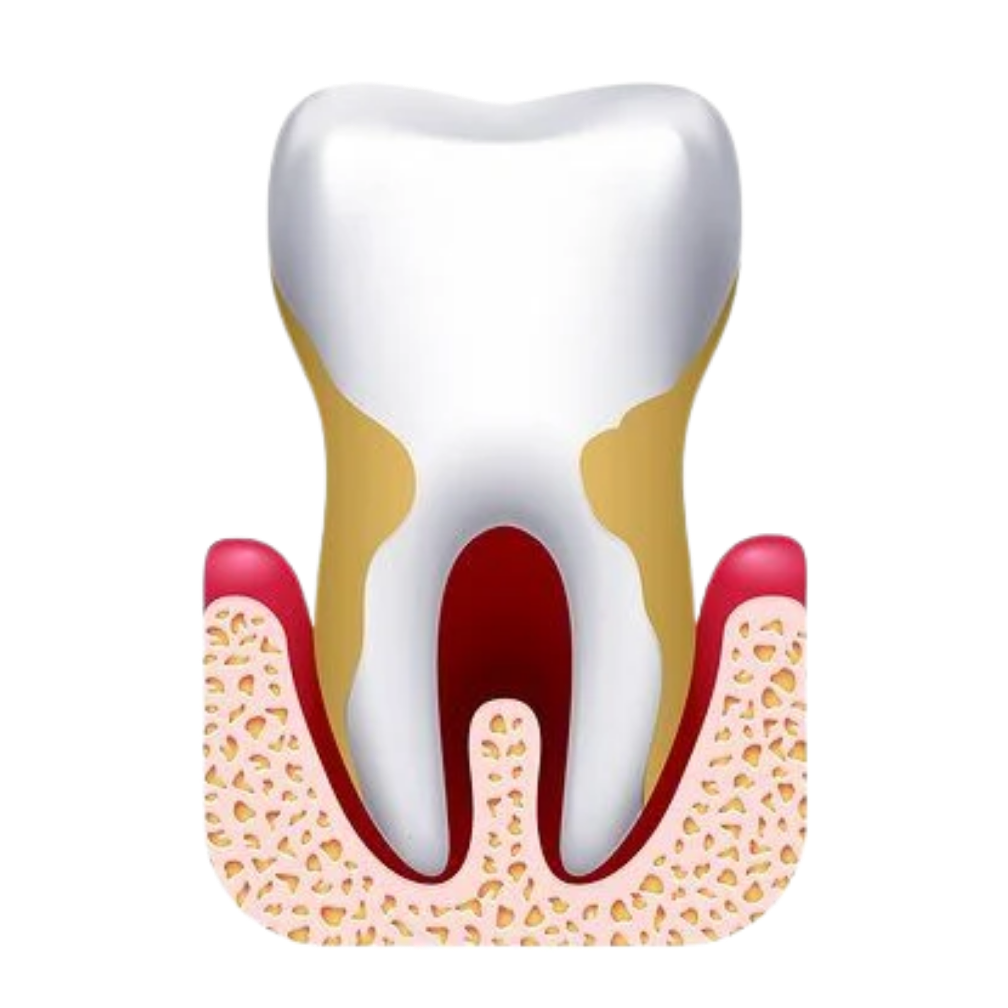 Illustration of advanced periodontitis showing significant bone loss and deep gum infection around a tooth