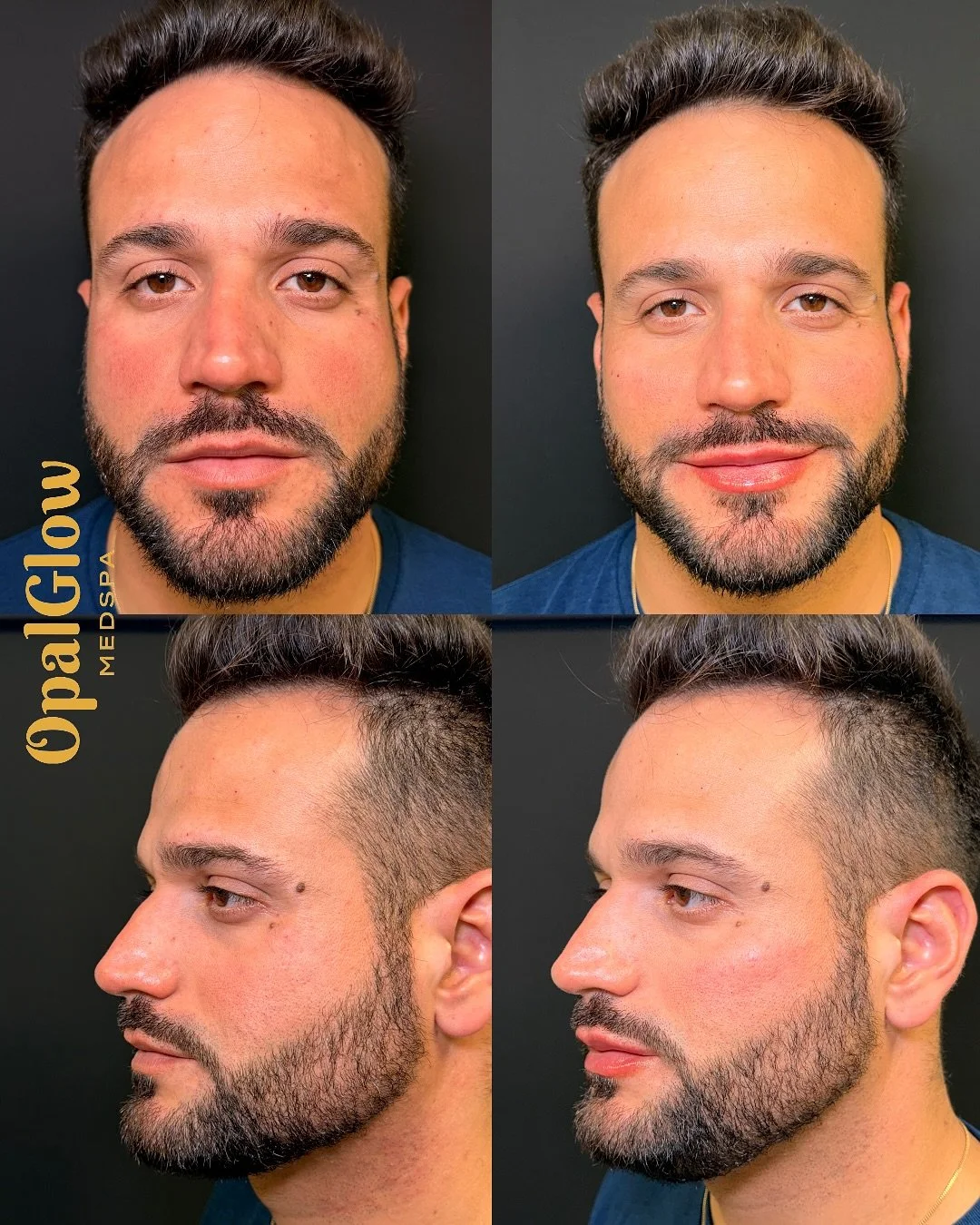 ✨ Confidence, Defined. ✨
Strategic lip + cheek filler to refresh, balance, and enhance masculine features, without changing what makes him unique.

Results:
✔️ Sharper, more contoured cheeks
✔️ Natural, fuller lips

At OpalGlow Medspa, our goal is su