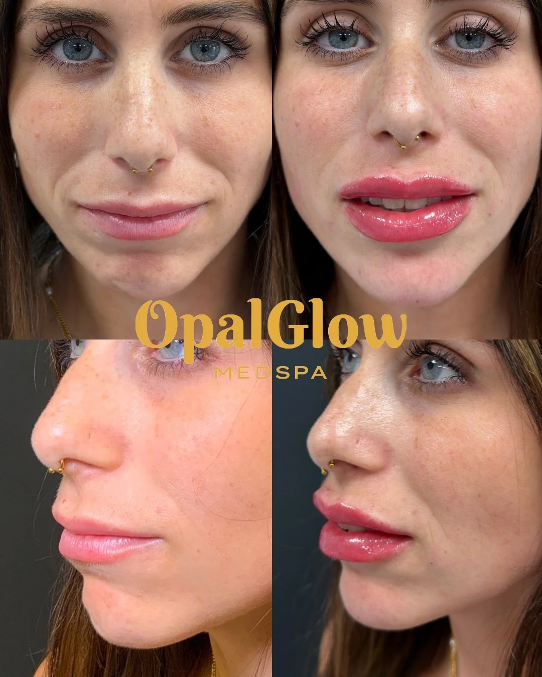 ✨ Lip goals, achieved. ✨
From subtle to statement &mdash; this gorgeous enhancement brings balance, volume, and definition while keeping a natural harmony with her features. 💋

Ready to love your lips? Book your consultation today.

#OpalGlowMedspa 