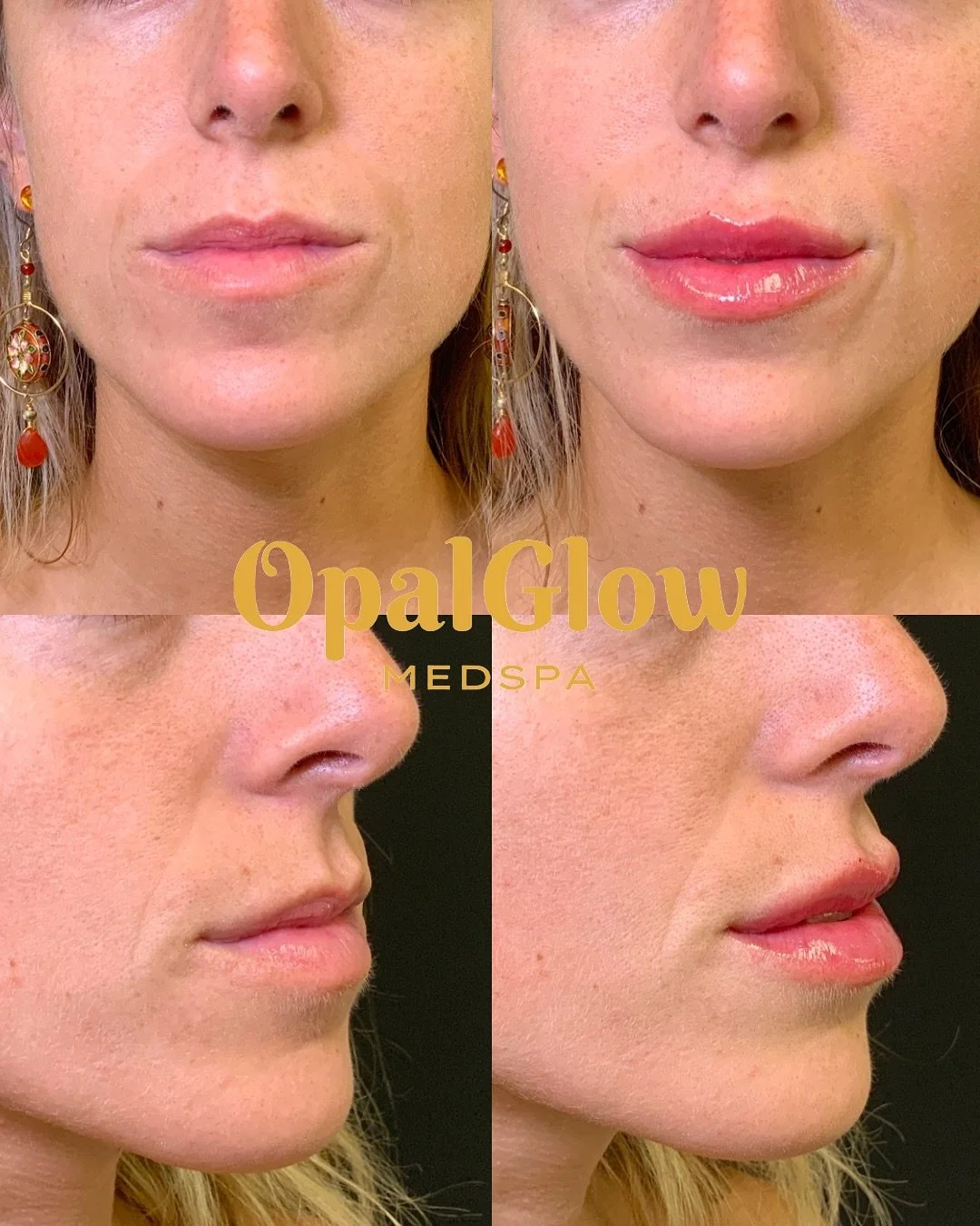 ✨ Sometimes less is more ✨ This patient came in with migrated and overfilled lips. We carefully dissolved the old filler and re-treated to restore balance, shape, and natural definition. Beautiful, soft results! 💋

#OpalGlowMedspa #LipEnhancement #a