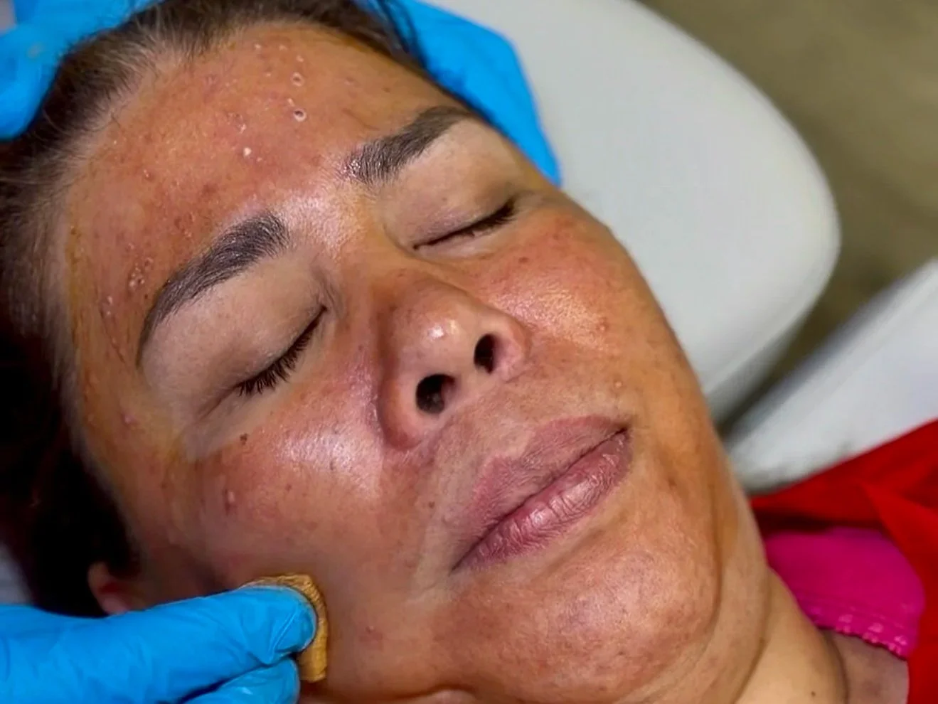 Chemical Peels: What They Are, Benefits, and What to Expect