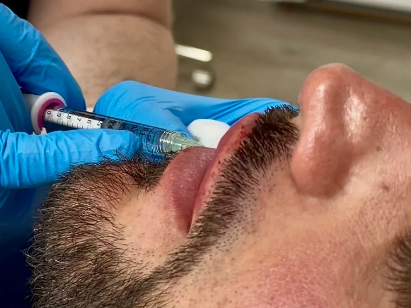 Lip Filler: What to Expect, Results, and First Time Guide