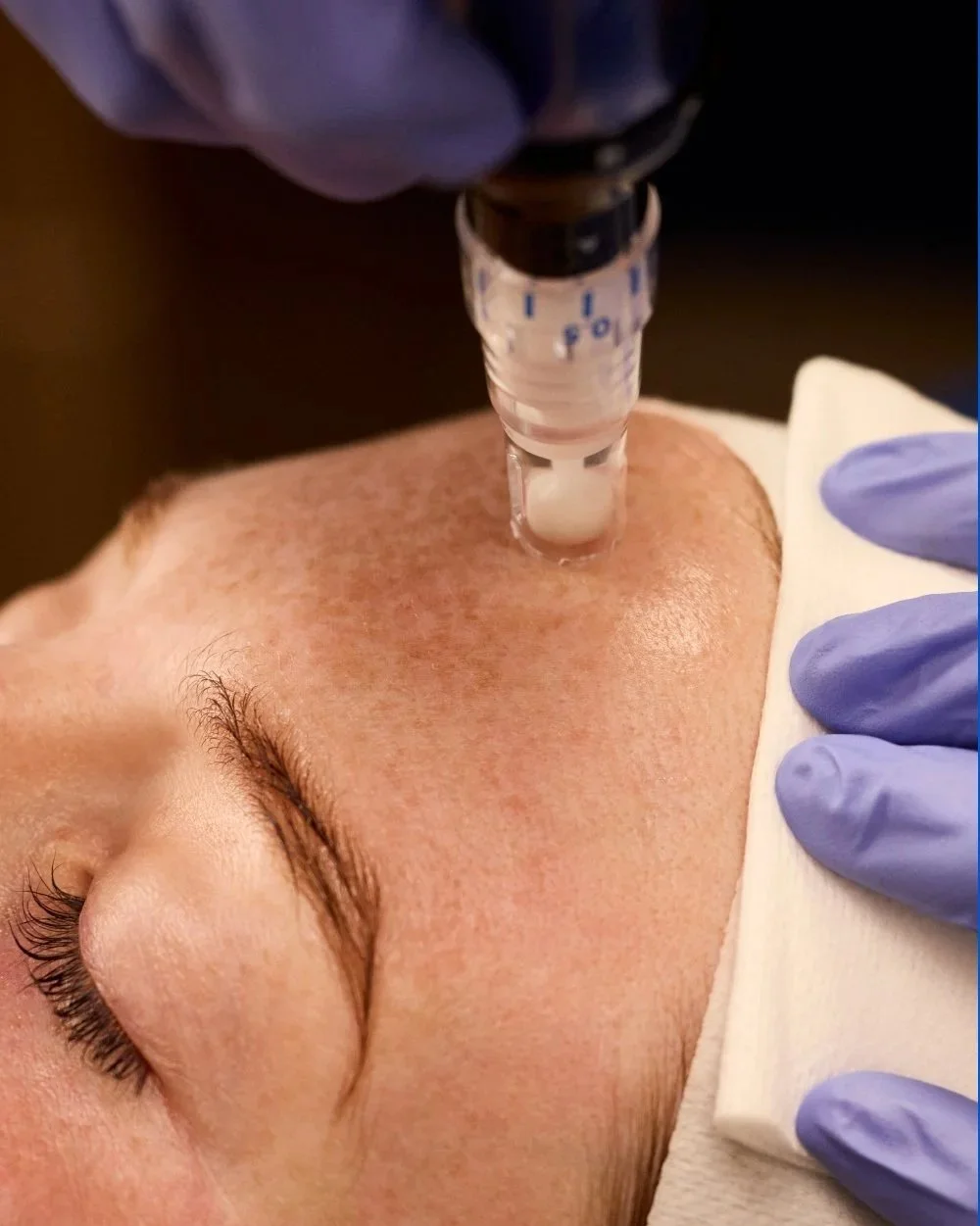 A person receiving a cosmetic injection into their forehead, with a healthcare professional wearing purple gloves holding a syringe and a cotton pad.