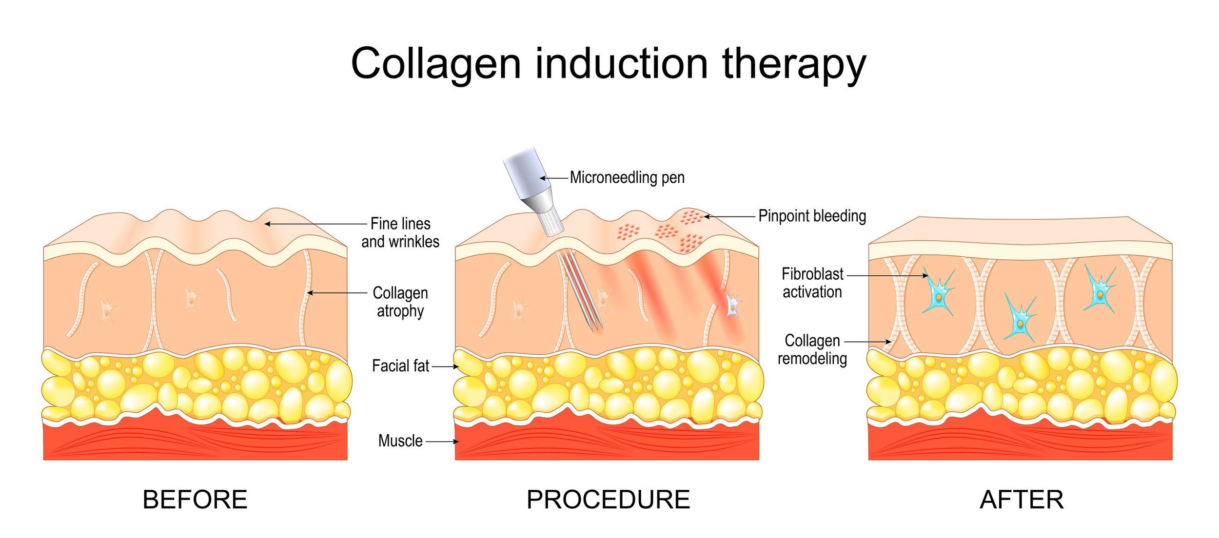Diagram showing how microneedling stimulates collagen and elastin production in the skin
