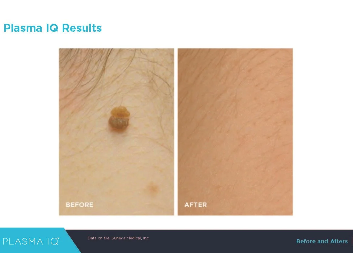 Before and after Plasma IQ treatment for benign skin lesion removal. OpalGlow Medspa Woodbridge NJ