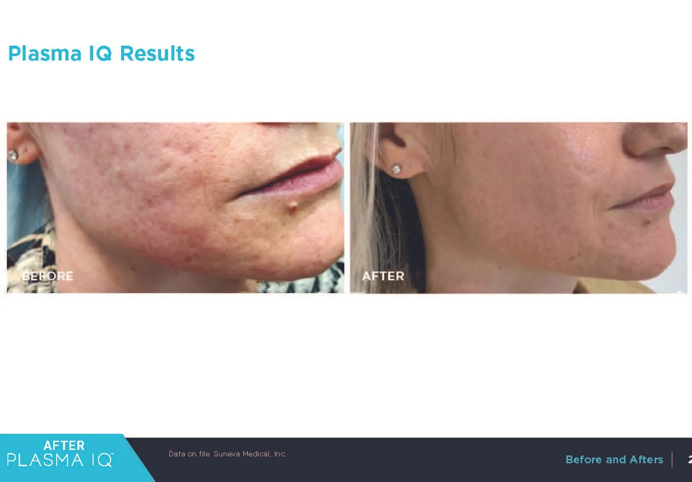 Plasma IQ treatment improving acne scars and skin texture before and after results. OpalGlow Medspa. Woodbridge, NJ.