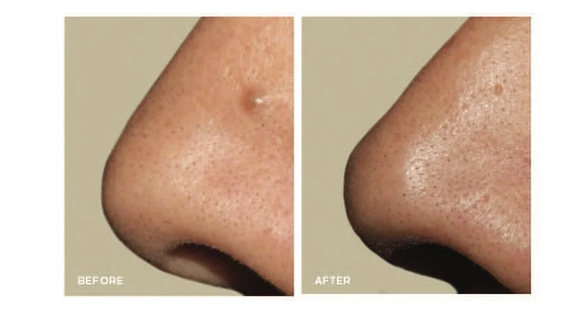 Plasma IQ treatment for sebaceous hyperplasia on the nose before and after results. OpalGlow Medspa. Woodbridge, NJ.