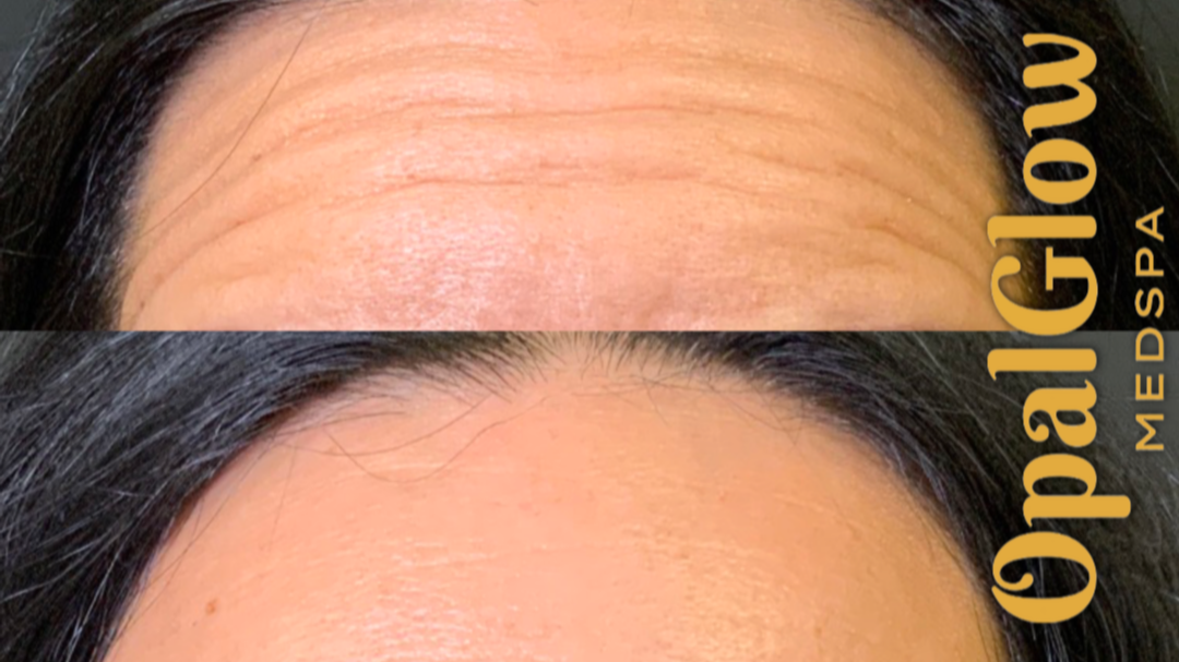 Forehead Botox before and after OpalGlow Medspa Woodbridge NJ