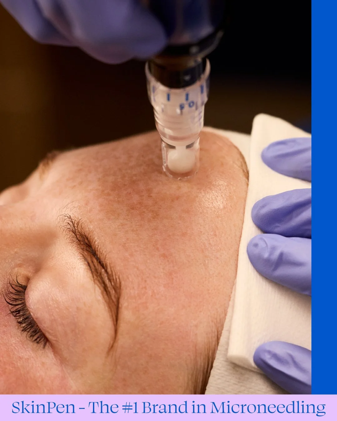 Microneedling with SkinPen for acne scars and skin rejuvenation in Woodbridge NJ at OpalGlow Medspa