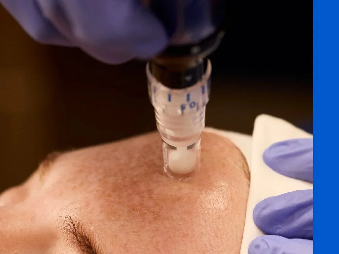 PRP Facial (Vampire Facial): What It Is, Benefits, and What to Expect